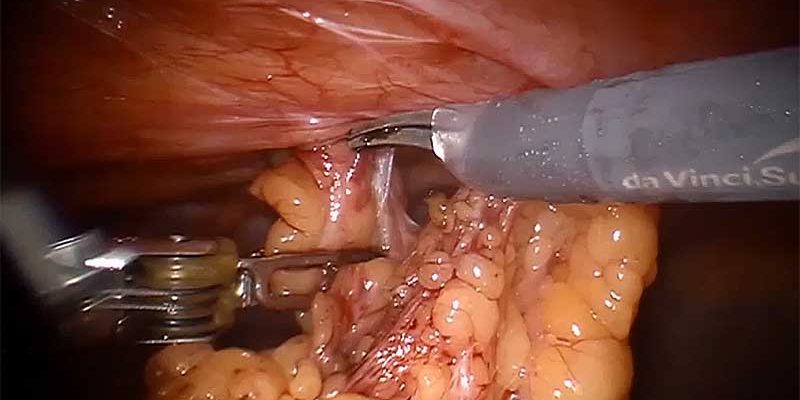 Ventral hernia repair in obese patient population.