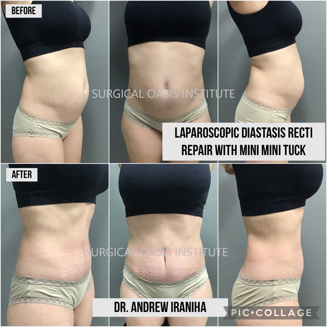 Orange County Laparoscopy Surgery Before and After Surgery Pictures