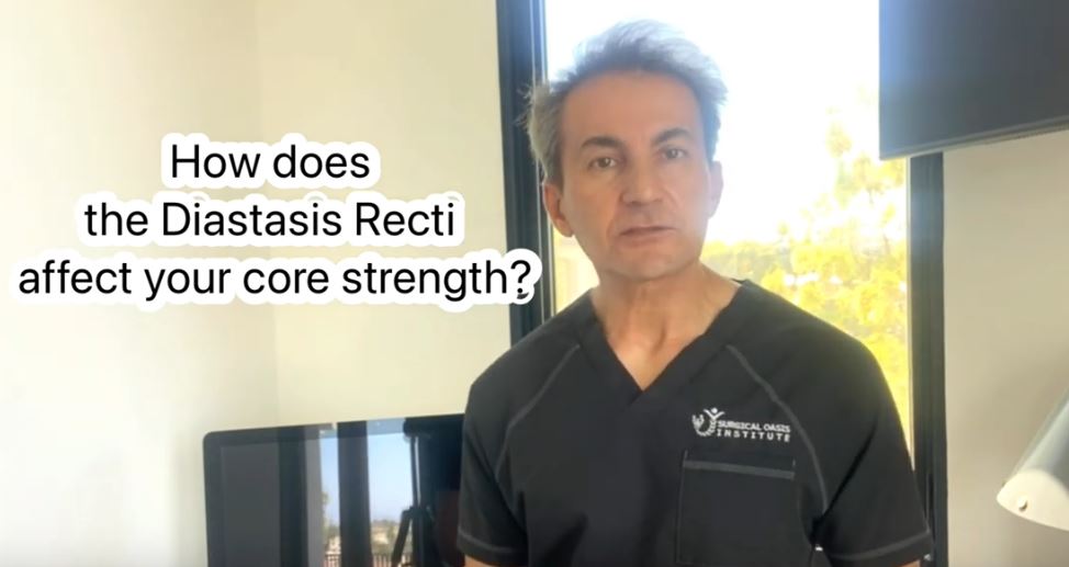 How does the Diastasis Recti affect your core strength by Dr. Iraniha