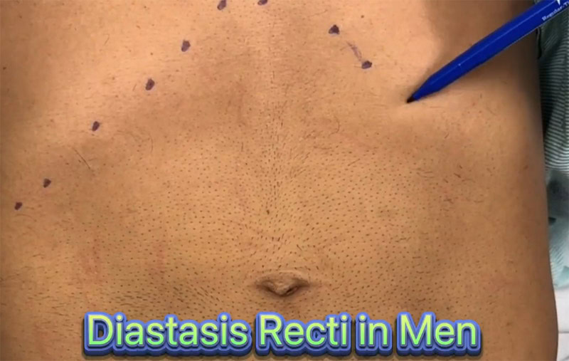 Diastasis Recti in Men by Dr. Iraniha