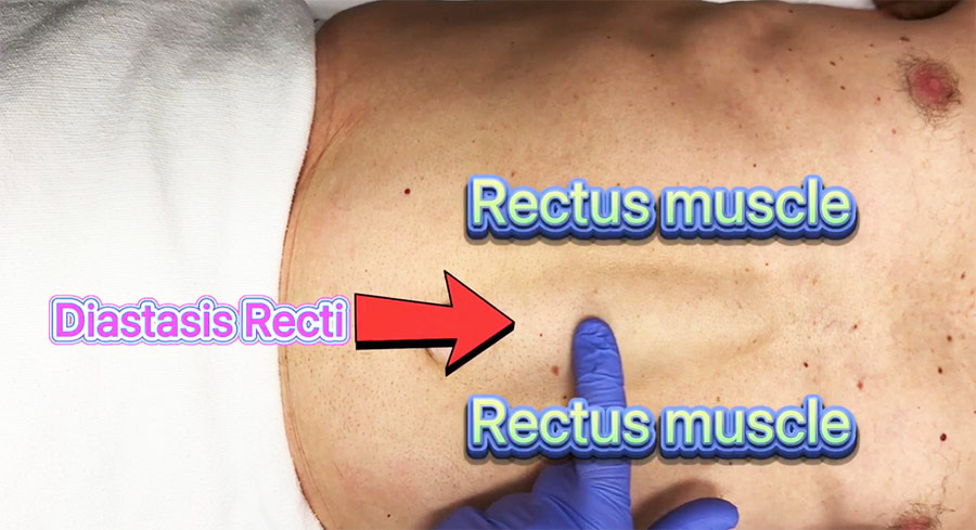 What can happen if you leave Diastasis Recti untreated - By Dr. Iraniha